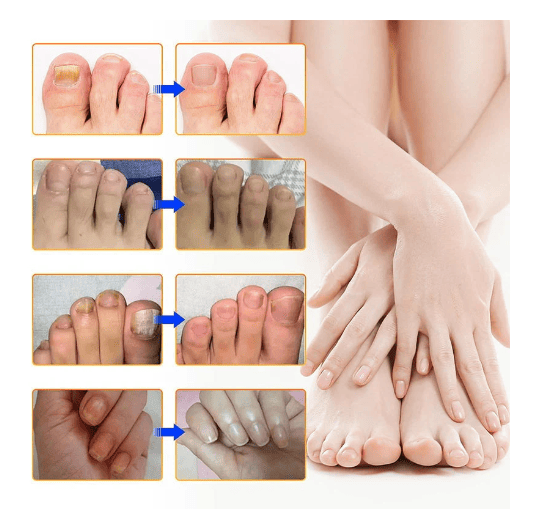 SleepCure  Patch réparateur antifongique pour les ongles