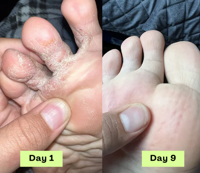 Gel de traitement contre les mycoses des ongles
