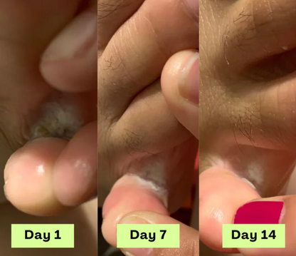 Gel de traitement contre les mycoses des ongles