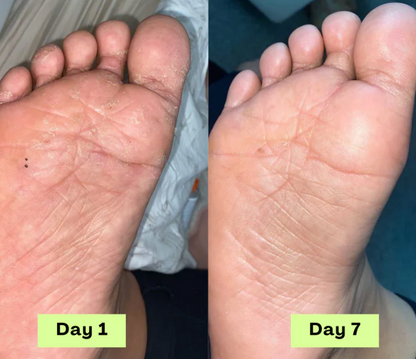 Gel de traitement contre les mycoses des ongles