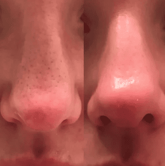 Dr Melaxin™ “Le peeling coréen liquide qui renouvelle votre peau en 24h