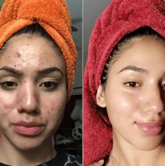 Dr Melaxin™ “Le peeling coréen liquide qui renouvelle votre peau en 24h