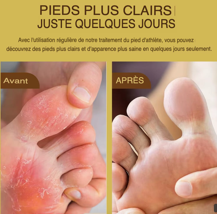 Gel de traitement contre les mycoses des ongles